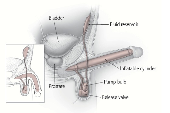 Penile prosthesis implantation