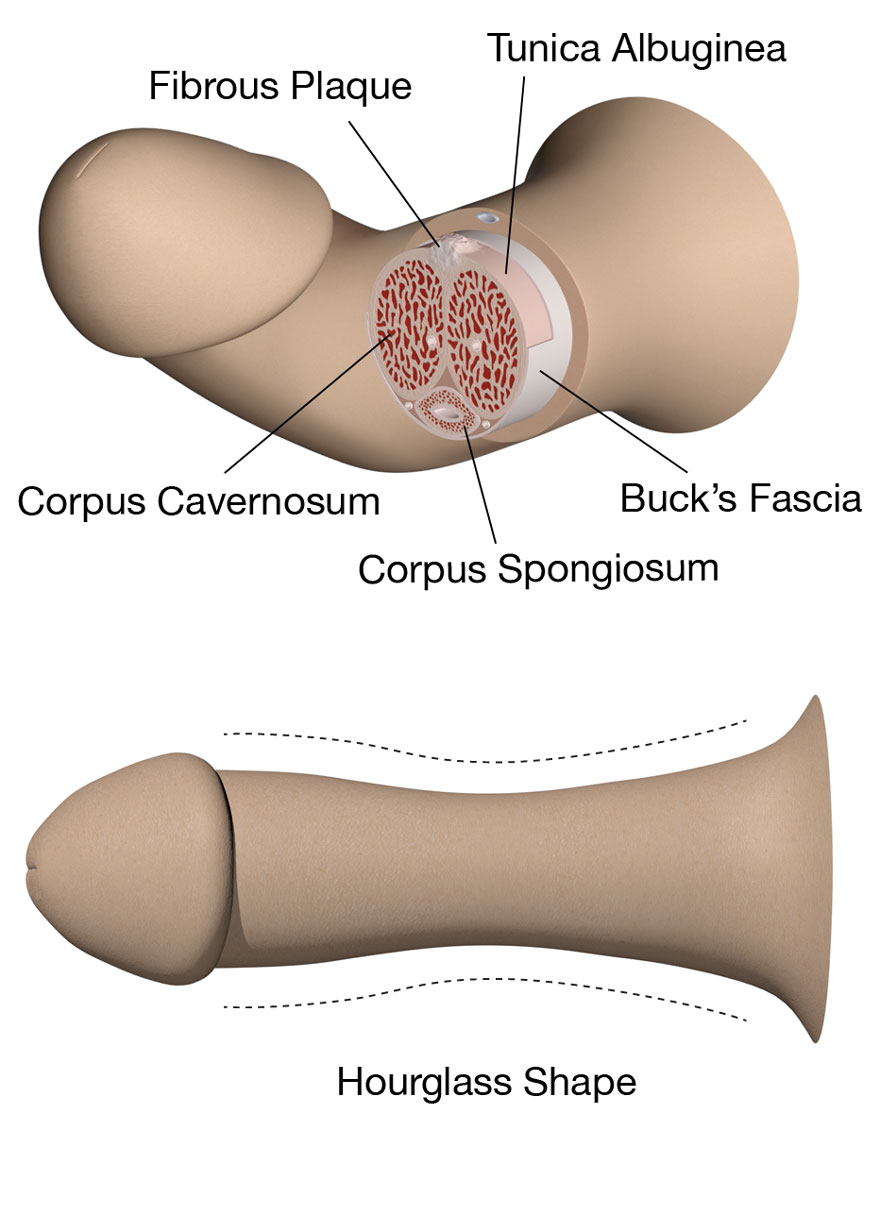 Peyronie's disorder