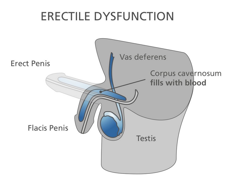 Erectile dysfunction